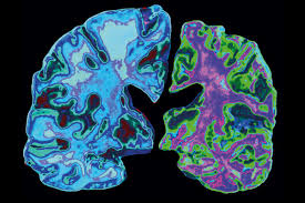 Alzheimer's Disease Detection